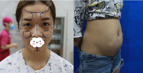 找深圳富华曹孟君做腰腹吸脂和面填后,我对自己身材脸蛋都满意