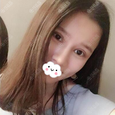 深圳美莱陈磊双眼皮隆鼻术后半年效果图 深圳美莱陈磊双眼皮隆鼻术后半年效果图