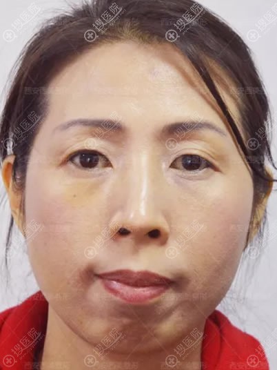 下巴短怎么改善?我选择西安西美做自体脂肪填充和假体垫下巴