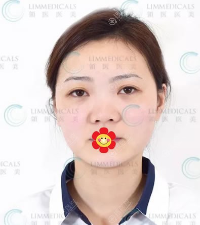 北京领医医疗美容员工用亲身体验告诉你崔相平做隆鼻子怎么样