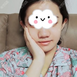 颌面整形术后7天面部出现变化 颌面整形术后7天面部出现变化