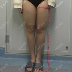 爆照:给大家看看我在深圳美加美做大腿抽脂3个月效果图