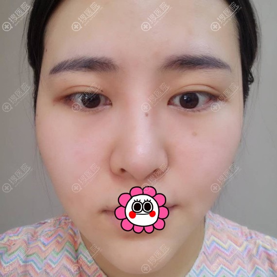 韩国拉菲安做轮廓整形怎么样?郑宰永颧骨整形案例和价格揭晓