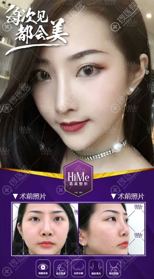 <!--<i data=20240710 data-id=9873></i>-->整形鼻综合隆鼻案例 <!--<i data=20240710 data-id=9873></i>-->整形鼻综合隆鼻案例