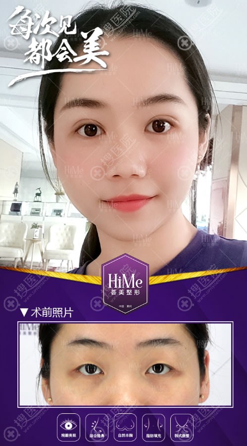 <!--<i data=20240710 data-id=11893></i>-->整形双眼皮案例 <!--<i data=20240710 data-id=11893></i>-->整形双眼皮案例
