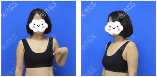 公开我花两万多元找郑州东方整形医院吴振做急速丰胸的亲身经历