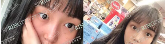 <!--<i data=20240710 data-id=17349></i>-->(原江南春天)杨淑云双眼皮术后对比效果 <!--<i data=20240710 data-id=17349></i>-->(原江南春天)杨淑云双眼皮术后对比效果