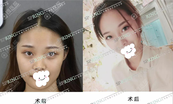 <!--<i data=20240710 data-id=17349></i>-->罗志敏隆鼻案例效果展示 <!--<i data=20240710 data-id=17349></i>-->罗志敏隆鼻案例效果展示