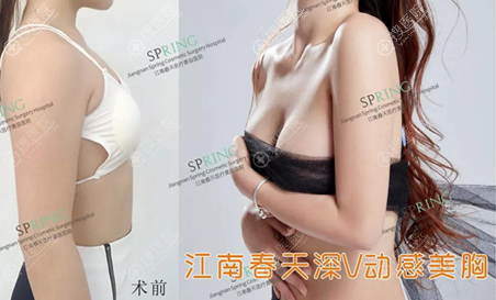 <!--<i data=20240710 data-id=17349></i>-->李钢丰胸案例效果图 <!--<i data=20240710 data-id=17349></i>-->李钢丰胸案例效果图