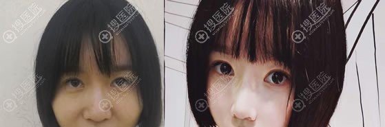 肇庆华美整形陈应华隆鼻案例 肇庆华美整形陈应华隆鼻案例