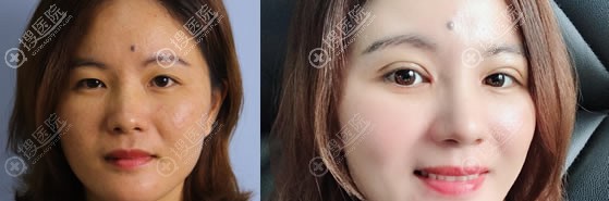 肇庆华美医院苏畅做双眼皮案例 肇庆华美医院苏畅做双眼皮案例