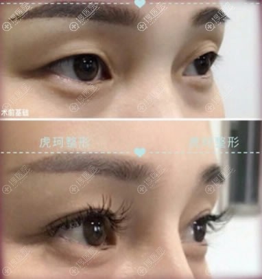 <!--<i data=20240710 data-id=13863></i>-->整形双眼皮案例 <!--<i data=20240710 data-id=13863></i>-->整形双眼皮案例