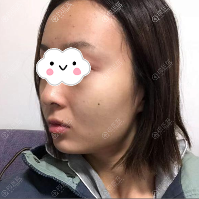 西安线雕哪家好?公开我去西安高一生找赵阳莉做的面部线雕案例
