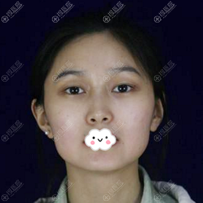用我的下颌角整形亲身经历告诉你上海仁爱医院刘先超磨骨怎么样