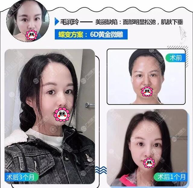 广州曙光全面部6D微雕对比效果 广州曙光全面部6D微雕对比效果