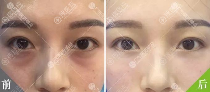 广州曙光脂肪型祛眼袋对比效果 广州曙光脂肪型祛眼袋对比效果