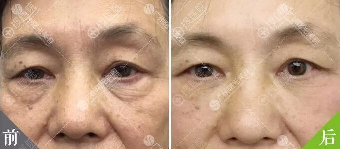 广州曙光松弛型眼袋对比效果 广州曙光松弛型眼袋对比效果