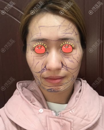 看看我前段时间在北京京韩做的全脸自体脂肪填充效果怎么样