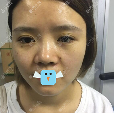 看了同学在深圳仁安雅做的双眼皮,我找苗春来做了鼻综合手术