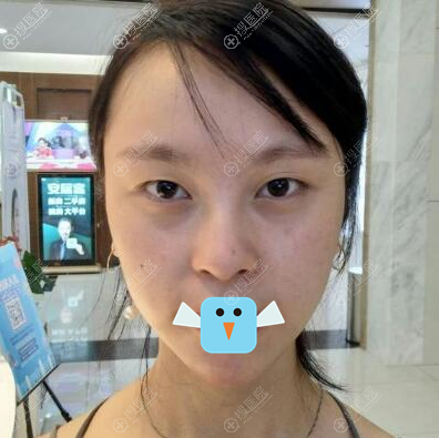 在于<!--<i data=20240710 data-id=12014></i>-->做眼睛下巴前的照片 在于<!--<i data=20240710 data-id=12014></i>-->做眼睛下巴前的照片