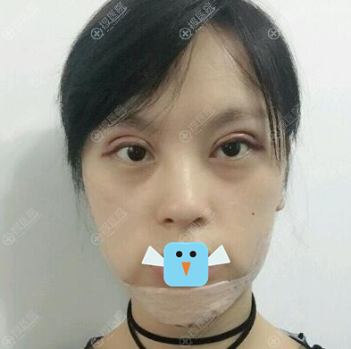 切开双眼皮+假体隆下巴术后1天 切开双眼皮+假体隆下巴术后1天