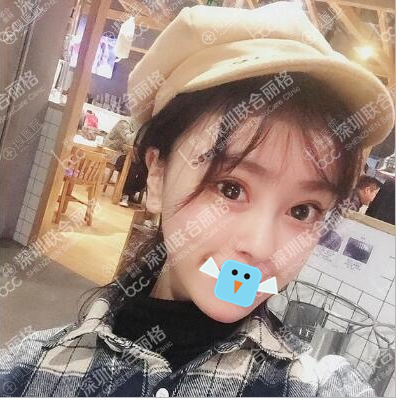 <!--<i data=20240710 data-id=12014></i>-->双眼皮+假体垫下巴术后效果图 <!--<i data=20240710 data-id=12014></i>-->双眼皮+假体垫下巴术后效果图