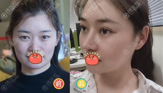 苏州紫馨顾陆健做双眼皮隆鼻案例 苏州紫馨顾陆健做双眼皮隆鼻案例