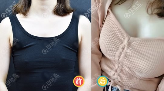 苏州紫馨整形汪涌假体隆胸案例 苏州紫馨整形汪涌假体隆胸案例