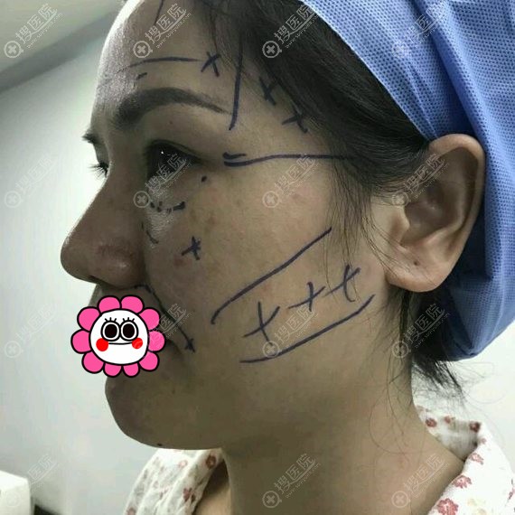 广州美恩纹绣医生自述做自体脂肪全脸填充后的效果和感受