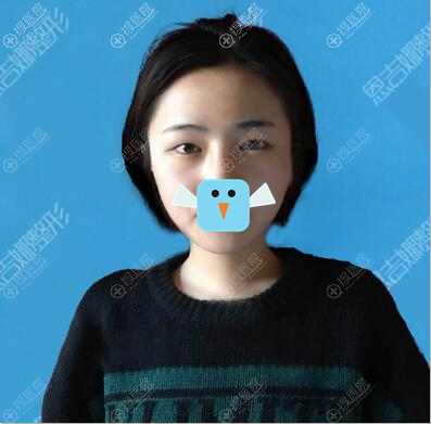 <!--<i data=20240710 data-id=11954></i>-->双眼皮术前照片 <!--<i data=20240710 data-id=11954></i>-->双眼皮术前照片