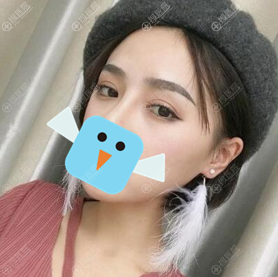 <!--<i data=20240710 data-id=11954></i>-->切开双眼皮术后半个月恢复效果 <!--<i data=20240710 data-id=11954></i>-->切开双眼皮术后半个月恢复效果