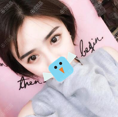 <!--<i data=20240710 data-id=11954></i>-->张锋双眼皮术后效果 <!--<i data=20240710 data-id=11954></i>-->张锋双眼皮术后效果