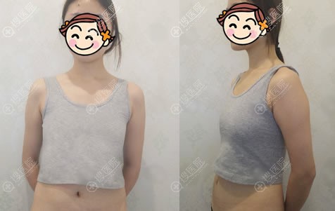 找南京美贝尔张永升做曼托假体隆胸4个月,看不出是做的假体胸了