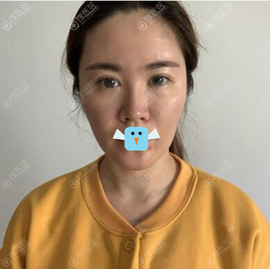 在深圳希思找石东文做了微创除皱术,分享拉皮手术术后13天图片