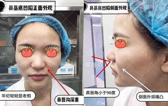 在杭州连天美将肋软骨隆鼻和肋软骨垫鼻基底一起做了后