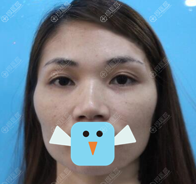 为了改善脸型,我在深圳丽港丽格找谢俊做了全面部脂肪填充手术