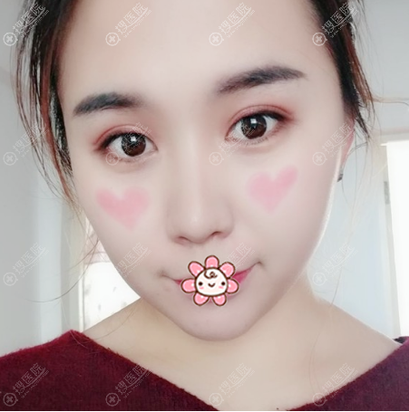 长春中妍整形医院费博文吉做的双眼皮案例 长春中妍整形医院费博文吉做的双眼皮案例