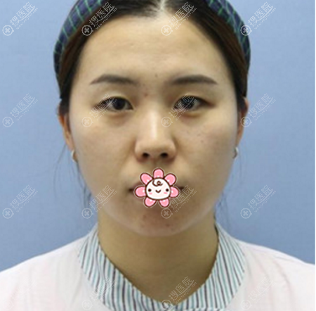 长春中妍整形医院双眼皮术前照片 长春中妍整形医院双眼皮术前照片