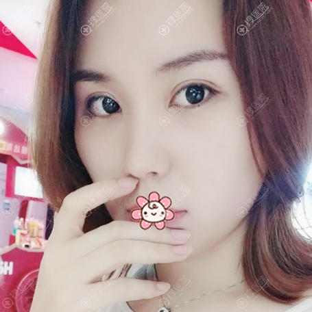 双眼皮开眼角术后一个月效果图 双眼皮开眼角术后一个月效果图