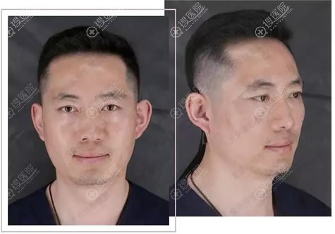 北京丽都文平邦主任竟然是吴玉家做的鼻子案例,揭晓效果怎么样