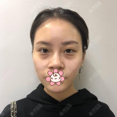 面诊感觉重庆铂生整形挺正规的就找杜亚旭做了全脸自体脂肪填充