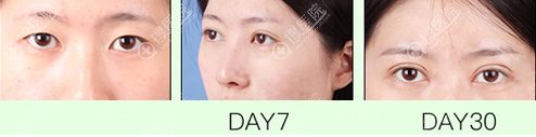 <!--<i data=20240710 data-id=12045></i>-->整形美容医院双眼皮案例图 <!--<i data=20240710 data-id=12045></i>-->整形美容医院双眼皮案例图
