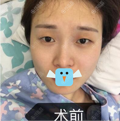在深圳铭医做双眼皮眼综合术前照 在深圳铭医做双眼皮眼综合术前照