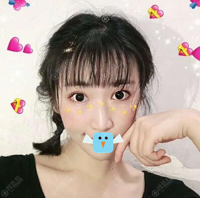深圳铭医刘昕眼综合术后效果图 深圳铭医刘昕眼综合术后效果图