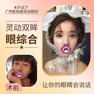 广州壹加壹双眼皮案例 广州壹加壹双眼皮案例