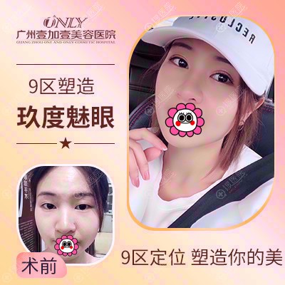 广州壹加壹项美莲双眼皮对比效果 广州壹加壹项美莲双眼皮对比效果