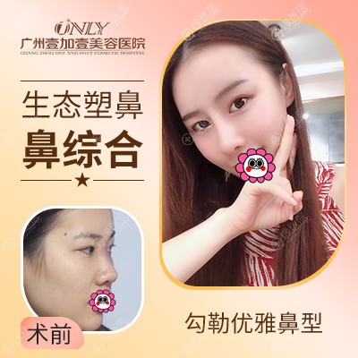 广州壹加壹李明做鼻子好吗 广州壹加壹李明做鼻子好吗