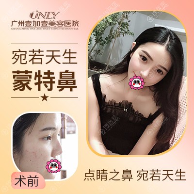 广州壹加壹李明蒙特鼻案例 广州壹加壹李明蒙特鼻案例