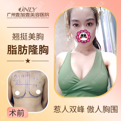 广州壹加壹项美莲脂肪隆胸对比图 广州壹加壹项美莲脂肪隆胸对比图