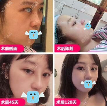 <!--<i data=20240710 data-id=11888></i>-->黄印资鼻综合术后恢复效果图 <!--<i data=20240710 data-id=11888></i>-->黄印资鼻综合术后恢复效果图